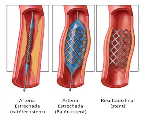AVC - Acidente Vascular Cerebral